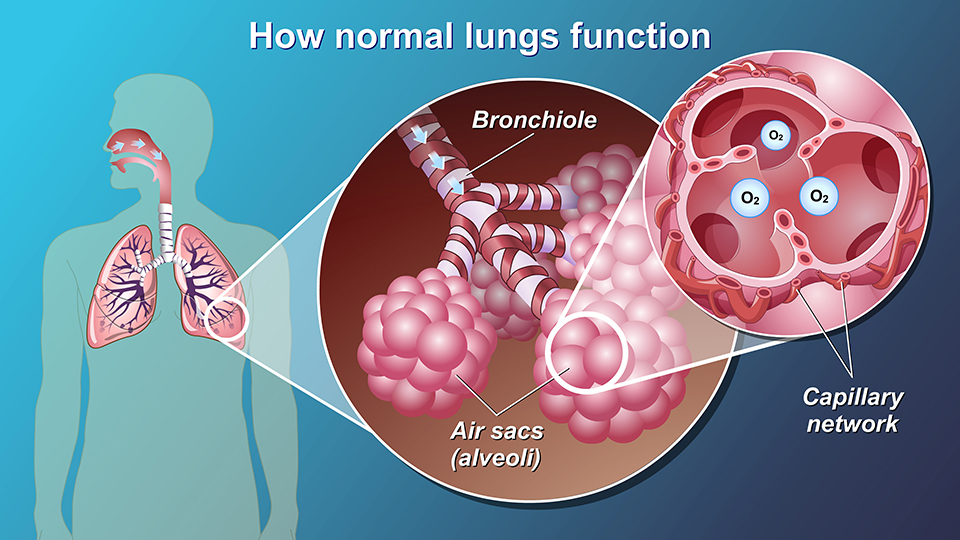 Animation - Understanding COPD