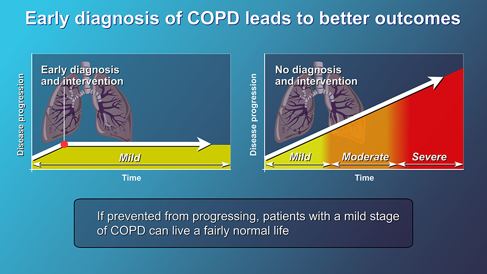 Diagnosis and Evaluation of COPD