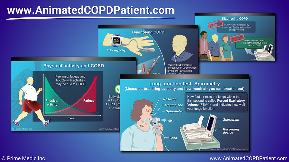 Diagnosis and Evaluation of COPD