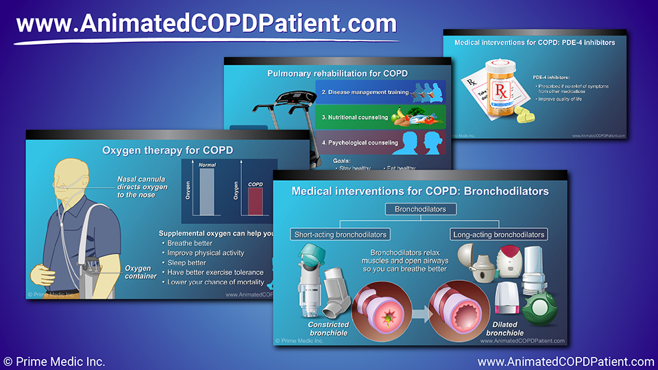 Slide Show - Management and Treatment of COPD