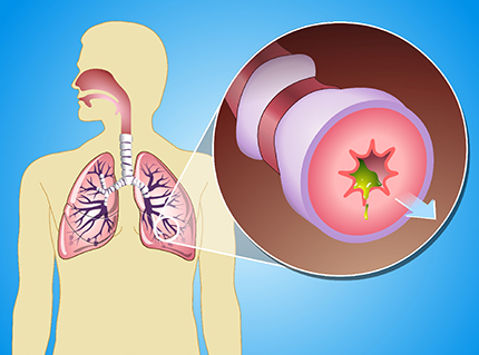 Understanding COPD